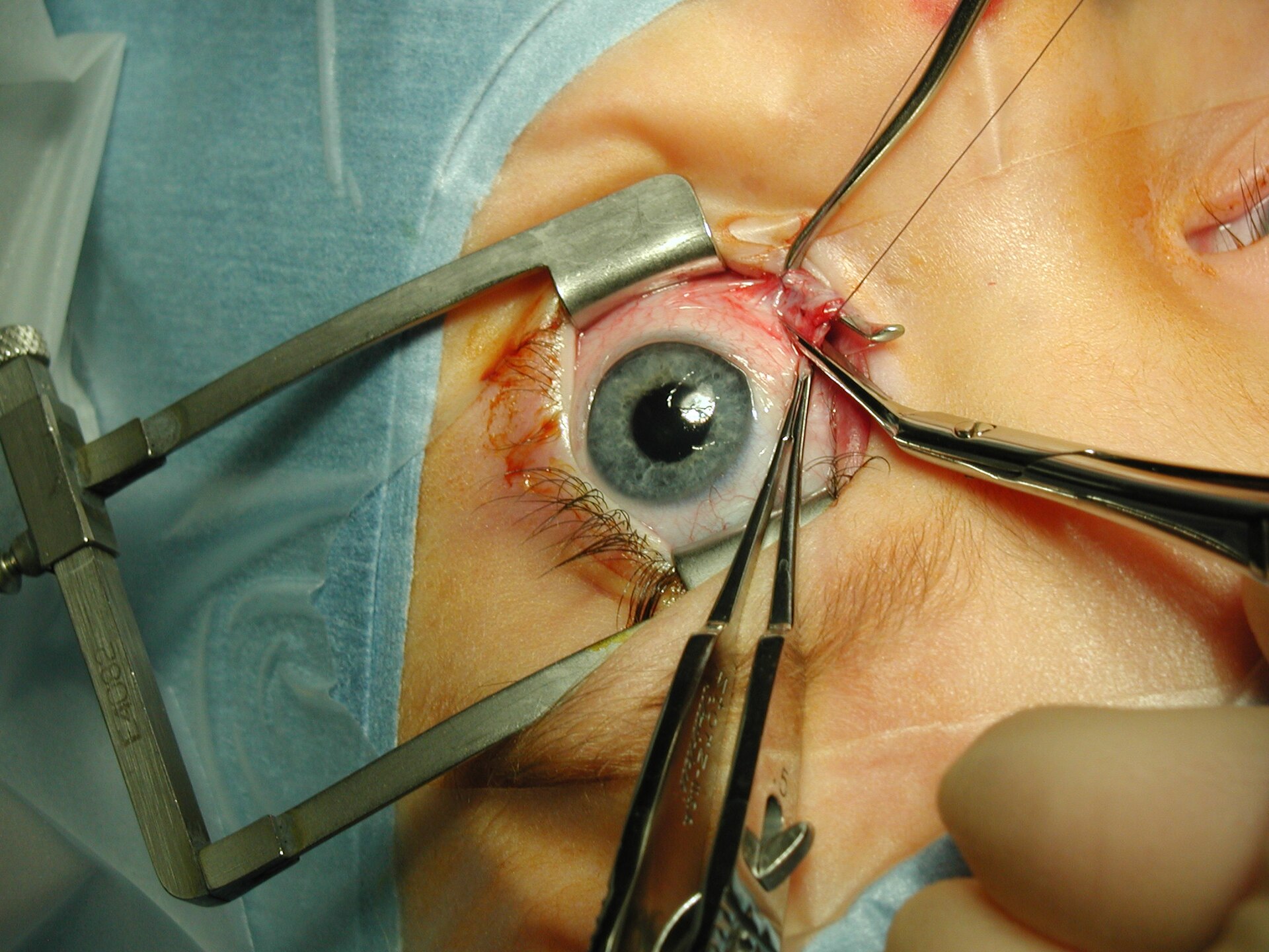 Imagem de referência relacionada a Cirurgia ocular, item descrito como registro de referência sobre Cirurgia ocular, organizado a partir de dados estruturados abertos