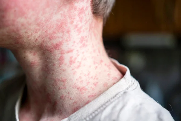 SP registra mais 2 casos de sarampo e estado chega a 32 diagnósticos