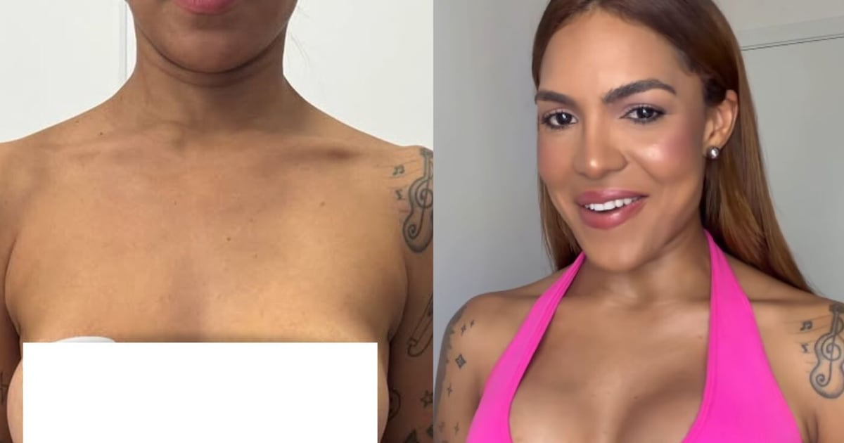 Tays Reis troca próteses de silicone após 11 anos e celebra primeiro decote pós‑mastopexia