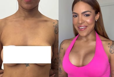 Tays Reis troca próteses de silicone após 11 anos e celebra primeiro decote pós‑mastopexia