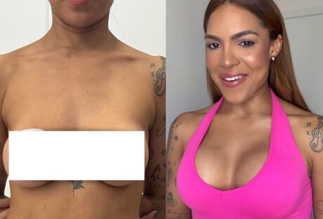 Tays Reis troca próteses de silicone após 11 anos e celebra primeiro decote pós‑mastopexia